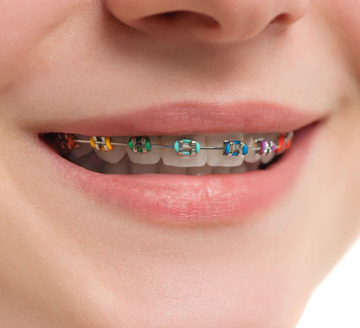 What type of orthodontics to choose?: Invisible brackets and aligners